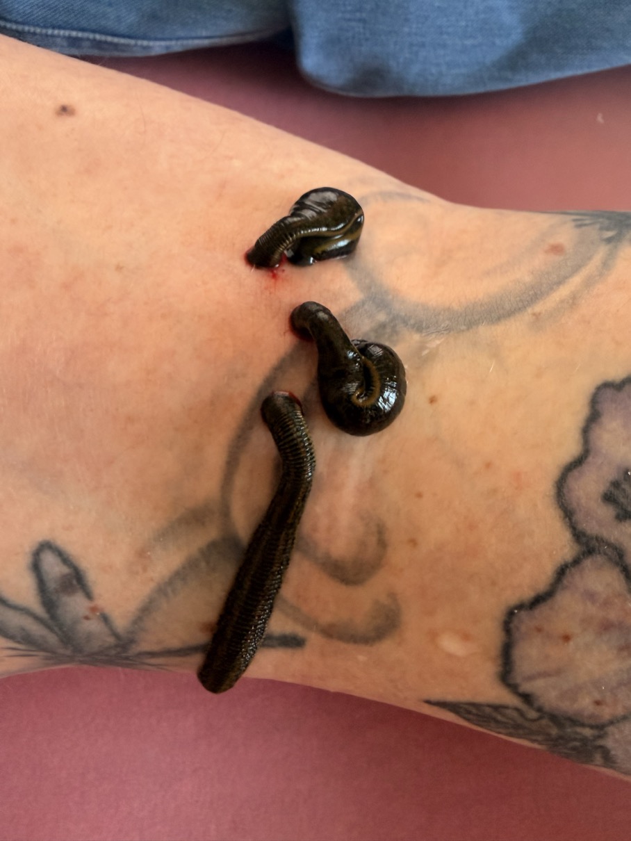 Blutegeltherapie in Lörrrach